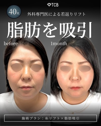 医療ハイフ（HIFU） | リフトアップはTCB東京中央美容外科