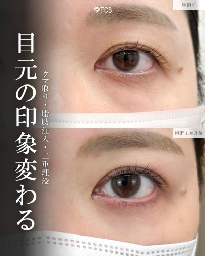皮膚を切らない目の下のクマ取り・たるみ（ふくらみ）取り | 美容整形