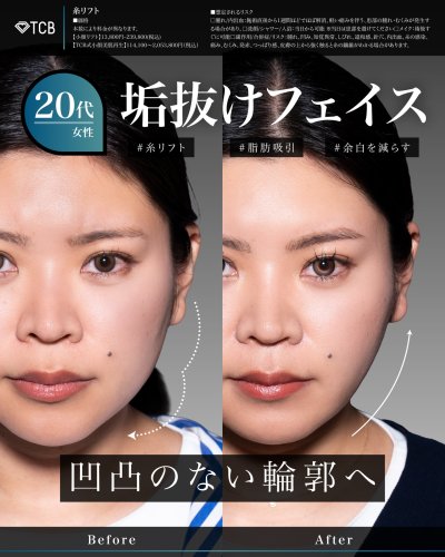 顔の脂肪吸引 | 美容整形はTCB東京中央美容外科