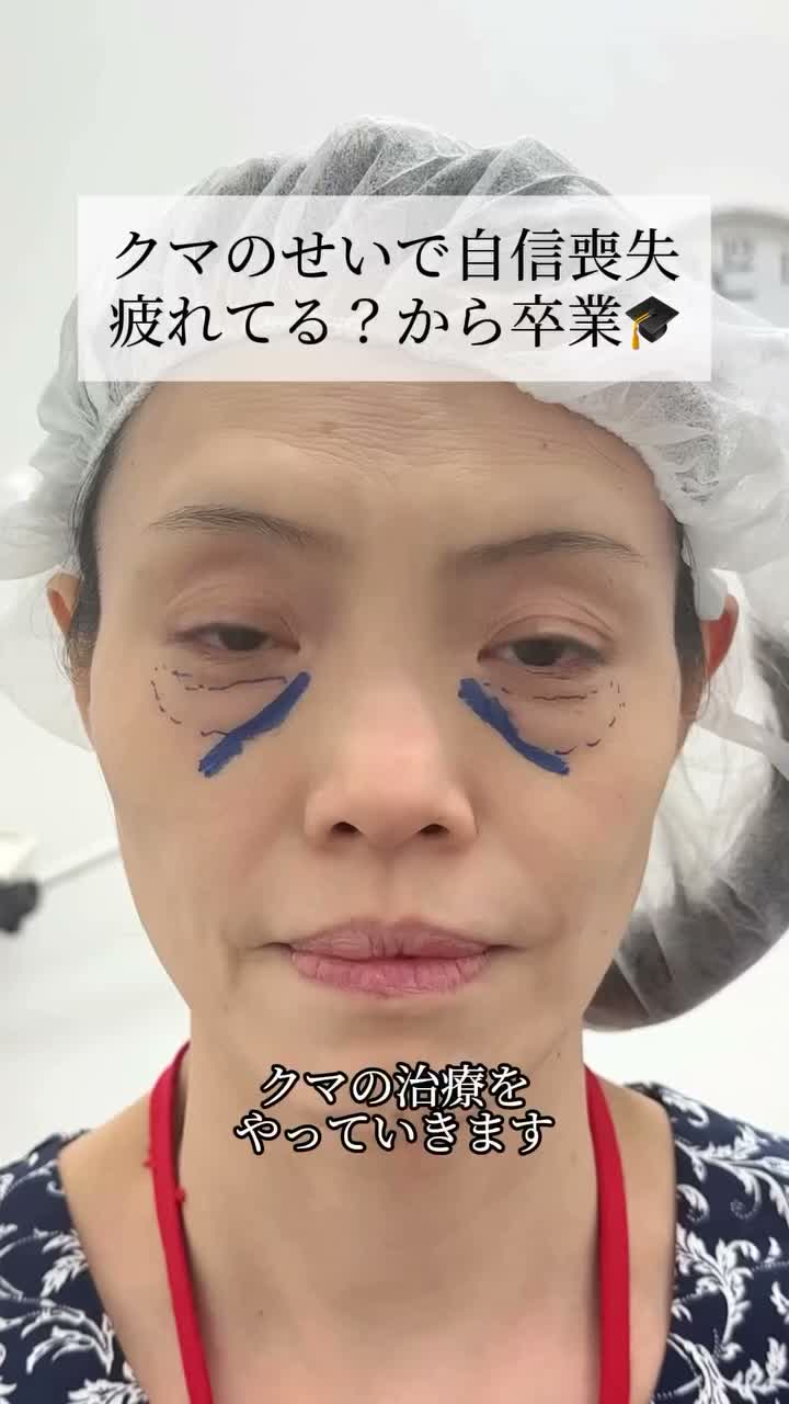 皮膚を切らない目の下のクマ取り・たるみ（ふくらみ）取り | 美容整形