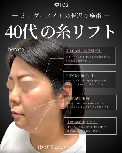 顔の脂肪吸引 | 美容整形はTCB東京中央美容外科