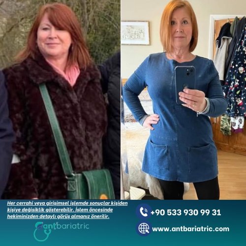 Photo post from antbariatric.