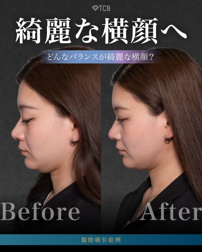 医療ハイフ（HIFU） | リフトアップはTCB東京中央美容外科