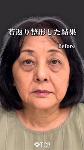 医療ハイフ（HIFU） | リフトアップはTCB東京中央美容外科