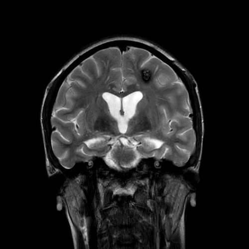 Carousel post from uchicagooptom.