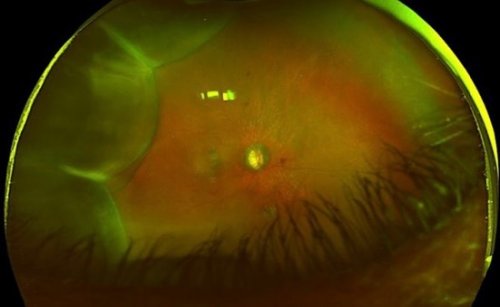 Carousel post from uchicagooptom.