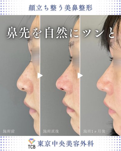 鼻形成術 Rebuilding Nose 教科書-