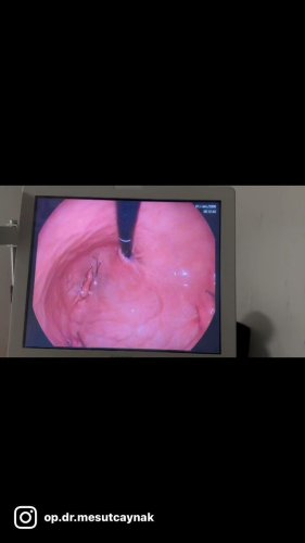 Video post from antbariatric.