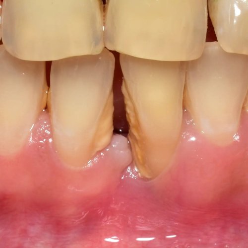Carousel post from delhiperiodontist.