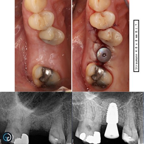 Photo post from galliperioimplants.