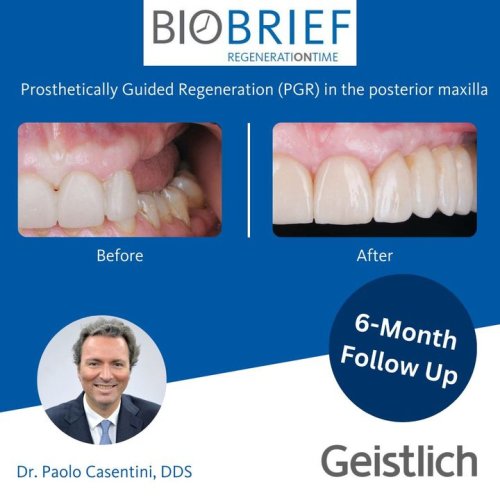 Carousel post from Geistlich Biomaterials - North America.