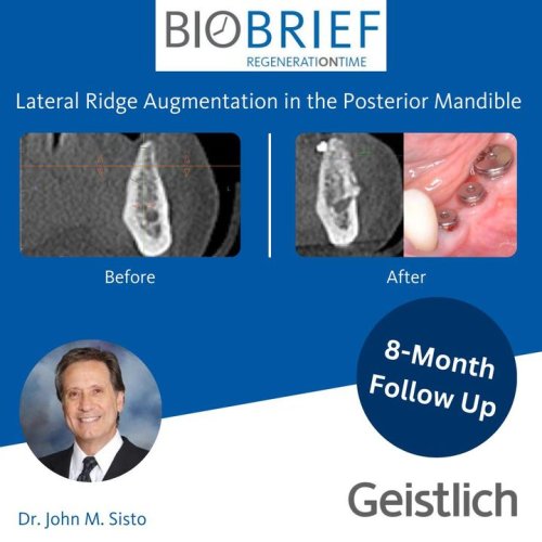 Carousel post from Geistlich Biomaterials - North America.