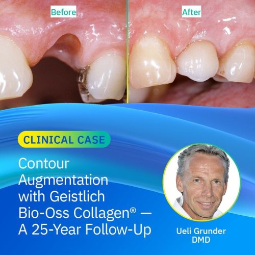 Carousel post from Geistlich Biomaterials - North America.