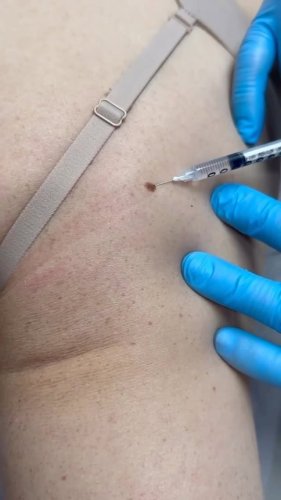 Video post from mandelderm.