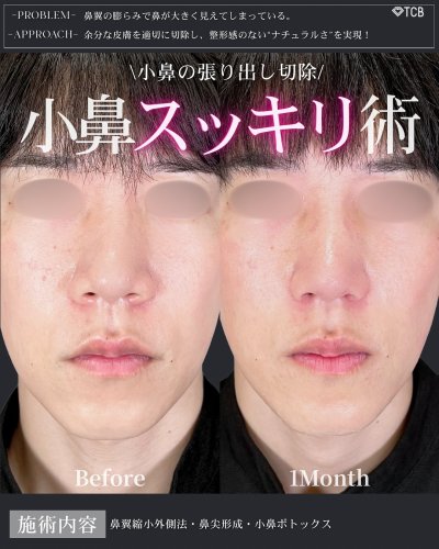 【裁断済み】鼻形成術 = 美容外科手術手技 裁断済み】鼻形成術 = 美容外科手術手技 克誠堂出版株式会社 on X: