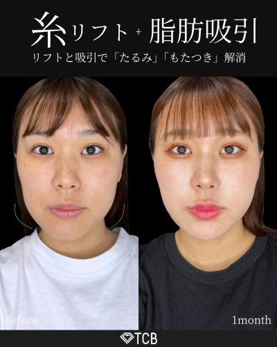 小顔整形・フェイスライン | 美容整形はTCB東京中央美容外科