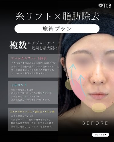 医療ハイフ（HIFU） | 小顔整形・リフトアップ | 美容整形はTCB