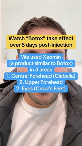 Video post from mandelderm.