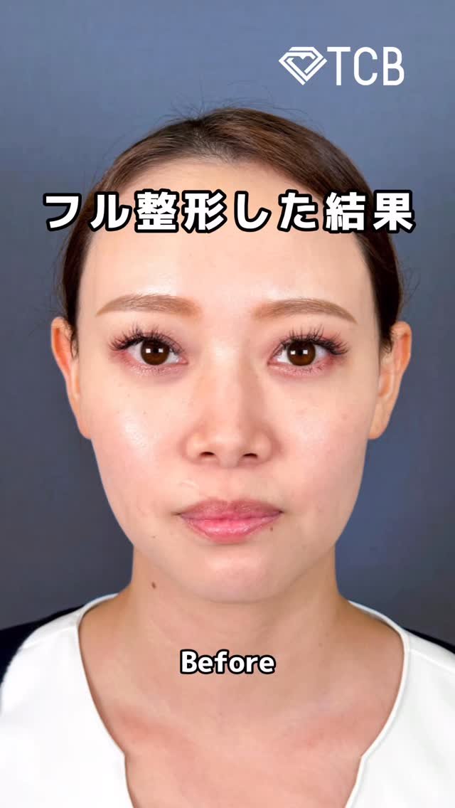 医療ハイフ（HIFU） | 小顔整形・リフトアップ | 美容整形はTCB