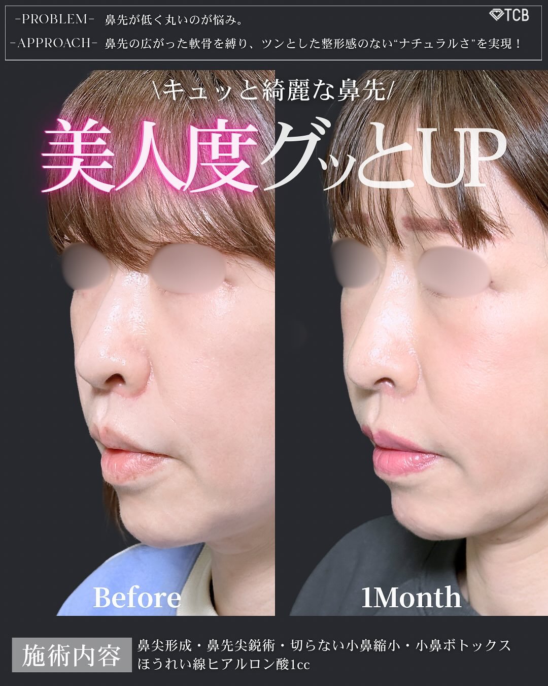 小鼻 垢抜けさせる鼻整形 【施術名】 鼻尖形成 3D法 軟骨移植 小鼻