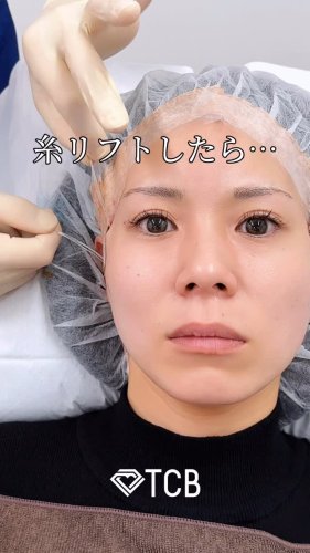 医療ハイフ(HIFU) | 小顔整形・リフトアップ | 美容整形はTCB 医療ハイフ(HIFU) | 小顔整形・リフトアップ | 美容整形はTCB