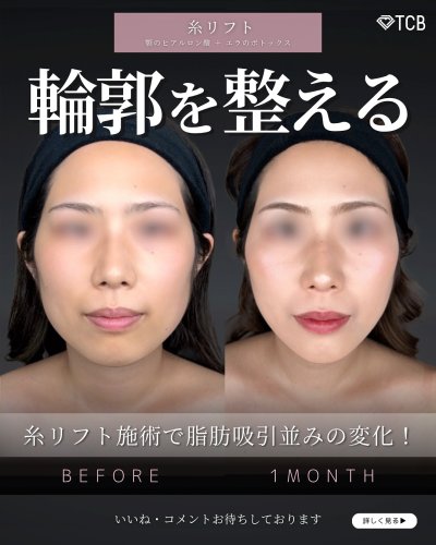 顔の美容外科手術 顔の脂肪吸引が上手い先生といえば湘南美容外科の葛島先生！症例