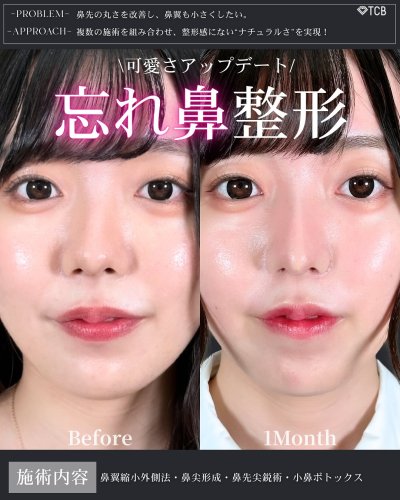小鼻 鼻翼縮小後の傷痕修正を行った症例です。 小鼻の溝に光沢のある