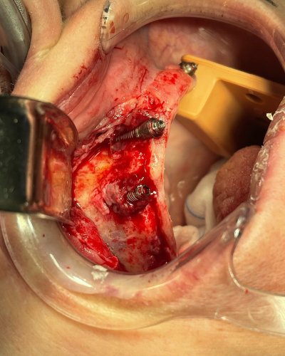 Carousel post from ottawaoralsurgery.