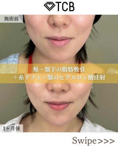 医療ハイフ（HIFU） | 小顔整形・リフトアップ | 美容整形はTCB東京 