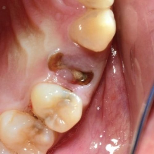 Carousel post from delhiperiodontist.