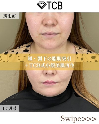 小顔整形・フェイスライン | 美容整形はTCB東京中央美容外科