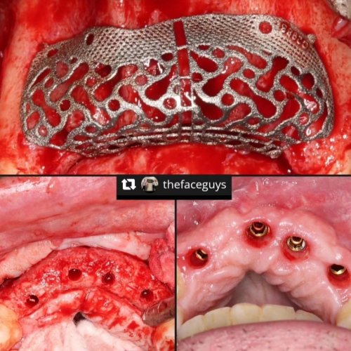Carousel post from guided_bone_regeneration.