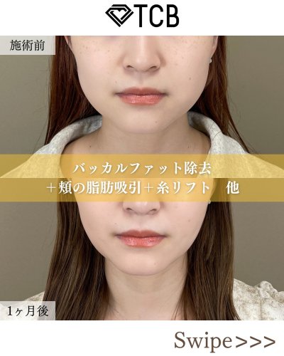 小顔整形・フェイスライン | 美容整形はTCB東京中央美容外科